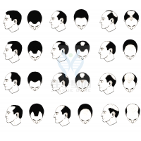 【bbin宝盈基因检测】过早<font color='red'>脱发</font>、掉发太多怎么办？你的方法可能是错的！